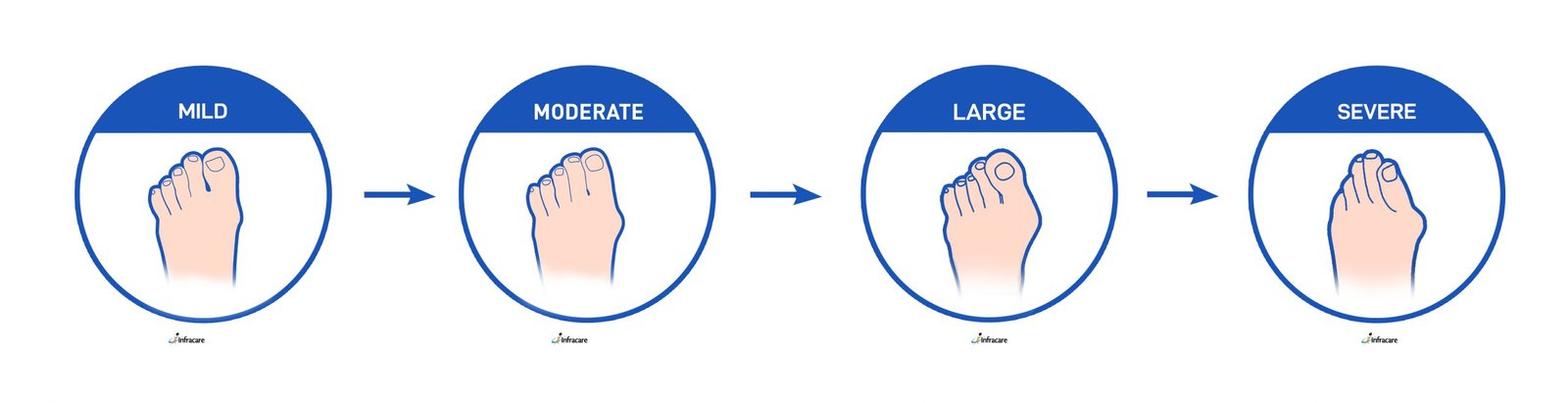 Infracare Bunion aligners